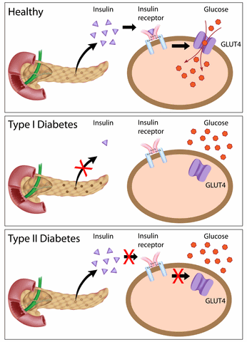 Wat is Suikerziekte